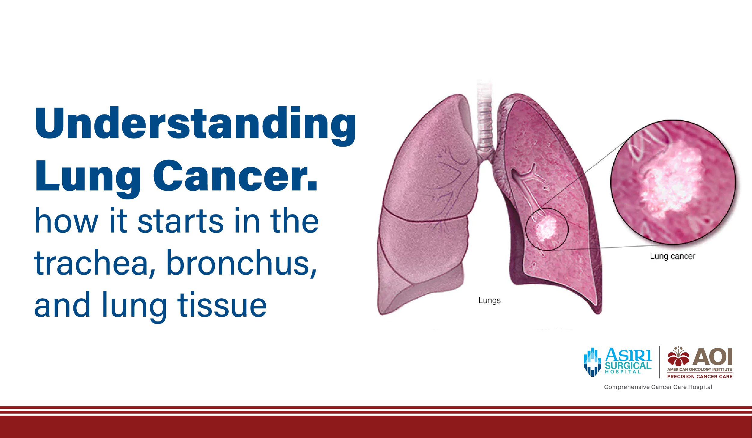 241129121128Understanding_Lung_Cancer_How_It_Starts_in_the_Trachea,_Bronchus,_and_Lung_Tissue-01.jpg